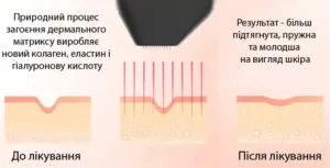 Indiba Reverso Апарат для відновлення шкіри та лікування шрамів